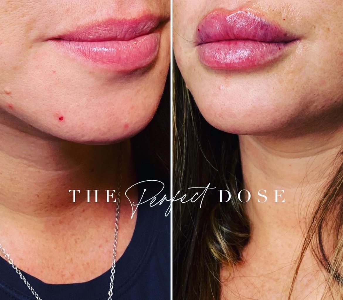 https://www.theperfectdose.net/wp-content/uploads/2024/10/lip-filler-bxa2.jpg